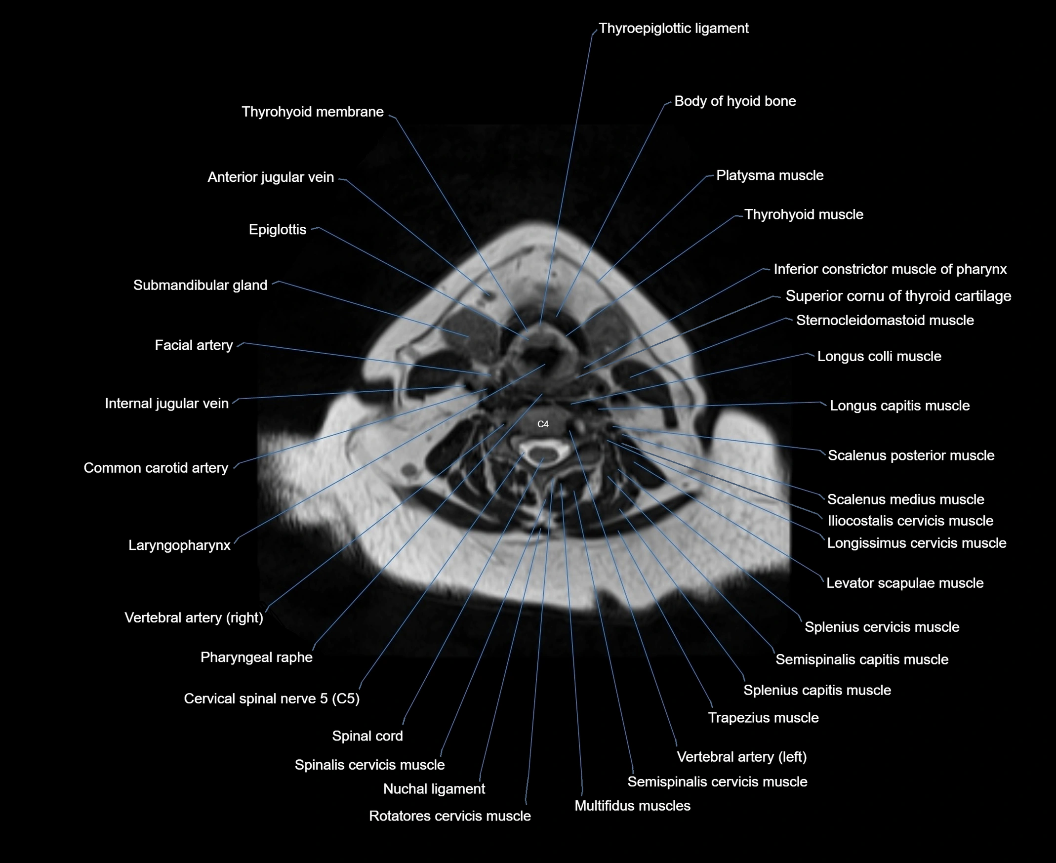 MRI Neck 3D labelled cross section anatomy axial 3t image-00001-00053.webp
